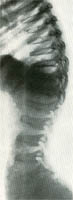 Fig. 63 - Rx Malattia di Morquio: marcati appiattimenti vertebrali con un aspetto anteriore dei corpi “a lingua” e “a fiamma”, gli spazi intervetebrali sono allargati.