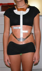 Fig 21a - Busto Milwaukee seMilwaukee Corset without cervical ring
