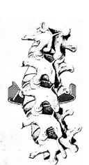 Fig 1  Il rachide ruota attorno all’asse longitudinale e alla rotazione si associa la torsione delle singole vertebre ; come conseguenza si ha:spostamento dei corpi vertebrali verso il lato convesso della curva, spostamento dei processi spinosi verso il lato concavo della curva, il gibbo costale