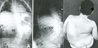 Fig. 42 - Paziente affetto da Distrofia muscolare di Duchenne (DMD) con notevole aggravamento in pochi mesi: quadro radiografico e clinico.