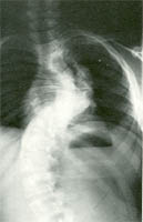 Fig. 45 – Neurofibromatosi: il radiogramma rivela una curva breve e con marcata angolatura.