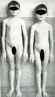 Fig. 47 - Sindrome di Marfan: dolicostenomelia (bambino a sinistra); bambino normale della 