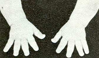 Fig. 57 - Acondroplasia: mani con dita corte, divergenti e di uguale lunghezza, aspetto detto di mani a tridente.
