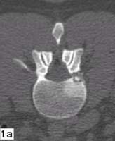 Fig. 65 Osteoma osteoide: la scansione TC sul piano trasversale (1a) e la ricostruzione su quello sagittale (1b) evidenziano la presenza di un piccolo osteoma osteoide del peduncolo Dx di L2 che aggetta nel forame di coniugazione. Da: Istituto Ortopedico Rizzoli. Bologna.