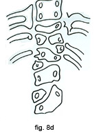 Fig. 8d Forma mista (anomalie multiple con difetti di formazione, di saldatura, di segmentazione e di fusione costale)